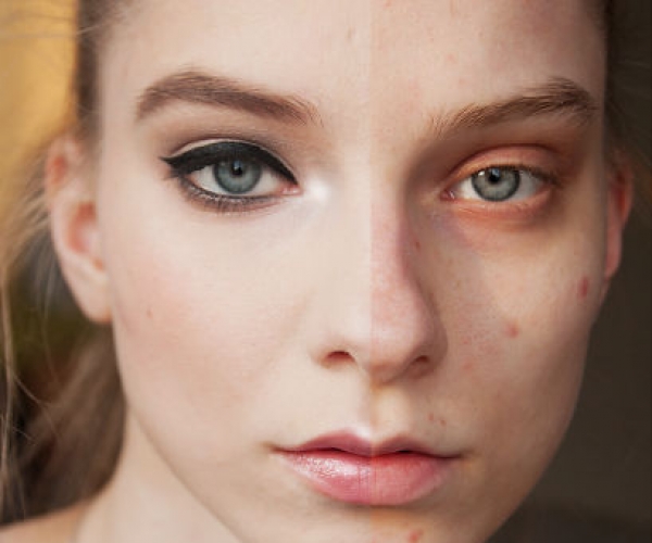 Cilt Lekeleri Makyajla Nasıl Kapatılır?