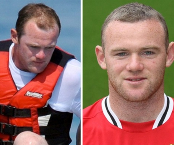 Wayne Rooney Saç Ektirdi